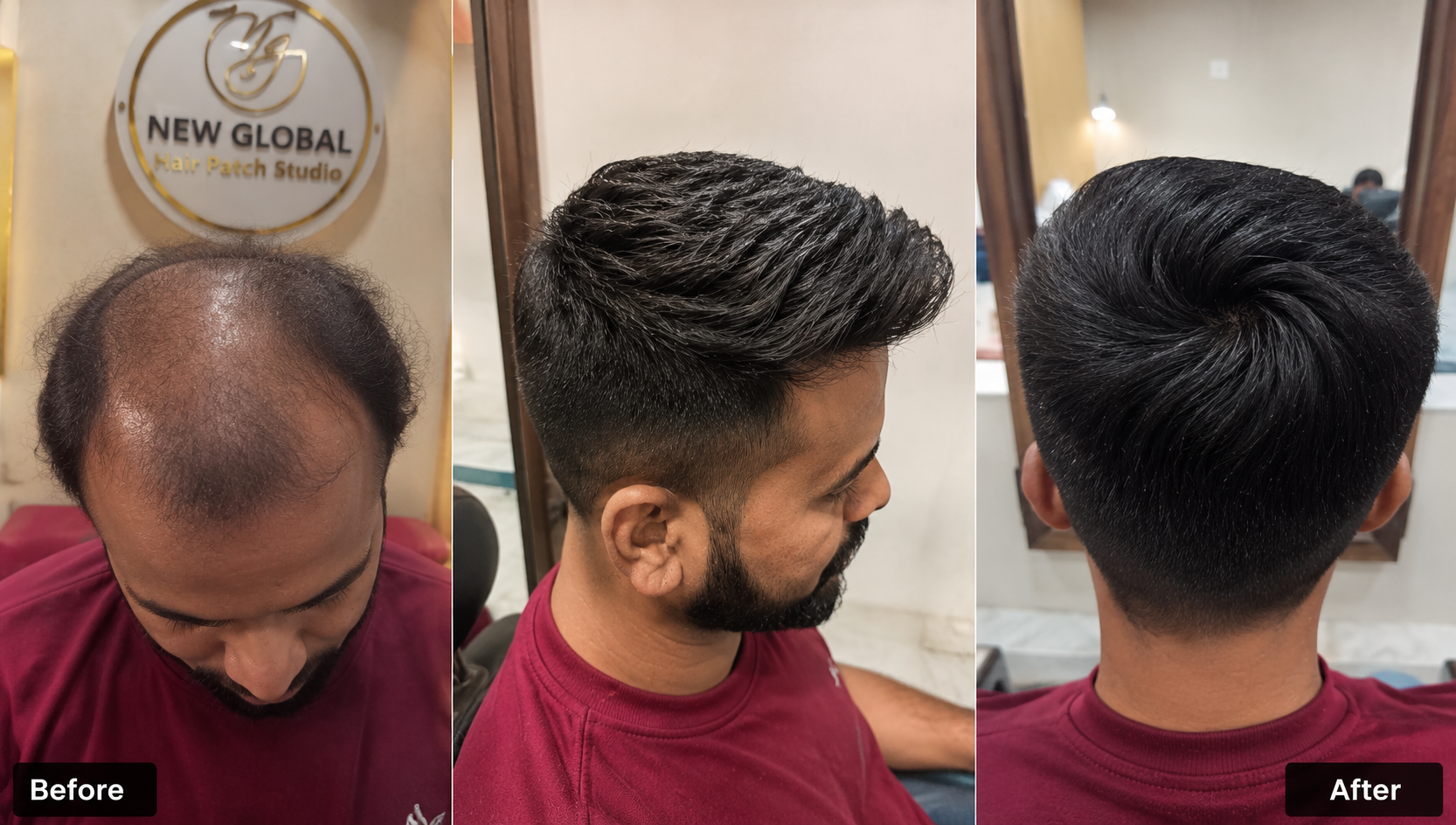 Before and after hair patch transformation — Custom Hair System — Undetectable Finish